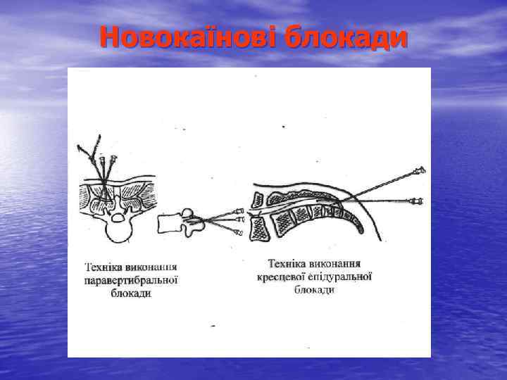 Новокаїнові блокади 