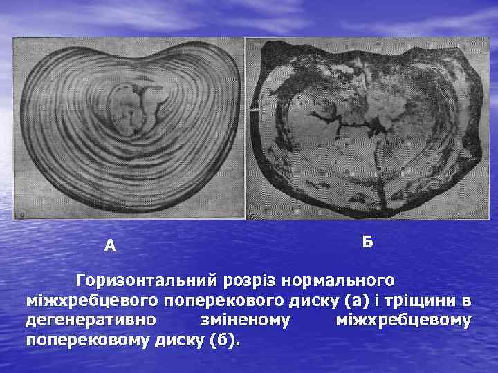 А Б Горизонтальний розріз нормального міжхребцевого поперекового диску (а) і тріщини в дегенеративно зміненому