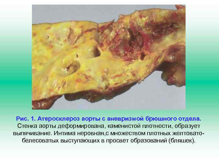 Рис. 1. Атеросклероз аорты с аневризмой брюшного отдела. Стенка аорты деформирована, каменистой плотности, образует