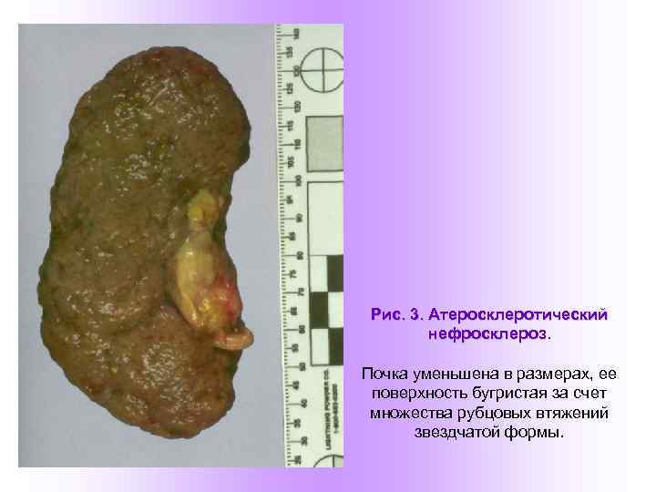 Рис. 3. Атеросклеротический нефросклероз. Почка уменьшена в размерах, ее поверхность бугристая за счет множества