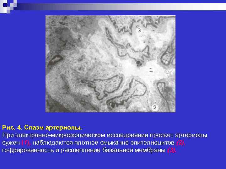 Рис. 4. Спазм артериолы. При электронно-микроскопическом исследовании просвет артериолы сужен (1), наблюдаются плотное смыкание