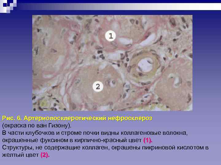 Рис. 6. Артериолосклеротический нефросклероз (окраска по ван Гизону). В части клубочков и строме почки