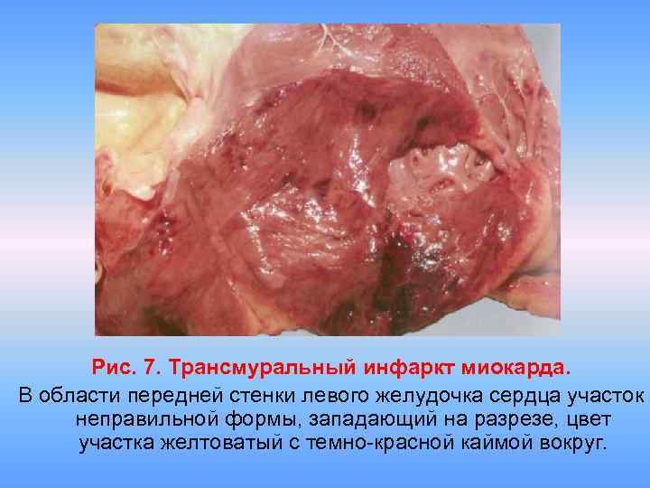 Рис. 7. Трансмуральный инфаркт миокарда. В области передней стенки левого желудочка сердца участок неправильной