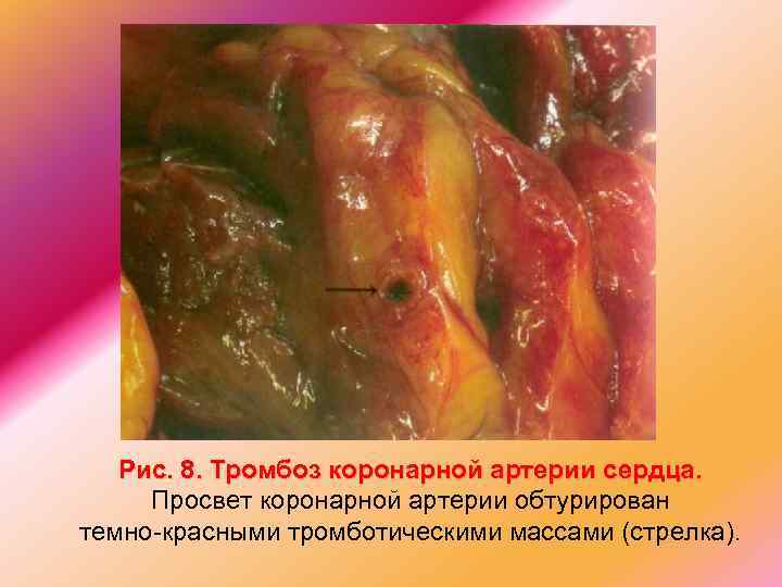 Рис. 8. Тромбоз коронарной артерии сердца. Просвет коронарной артерии обтурирован темно-красными тромботическими массами (стрелка).