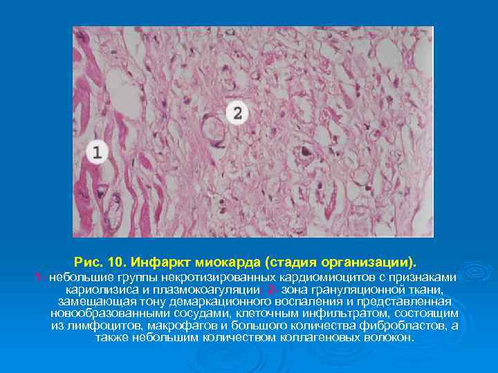 Рис. 10. Инфаркт миокарда (стадия организации). 1 - небольшие группы некротизированных кардиомиоцитов с признаками