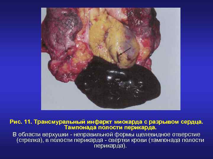 Рис. 11. Трансмуральный инфаркт миокарда с разрывом сердца. Тампонада полости перикарда. В области верхушки