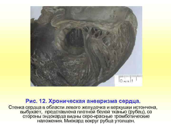 Рис. 12. Хроническая аневризма сердца. Стенка сердца в области левого желудочка и верхушки истончена,