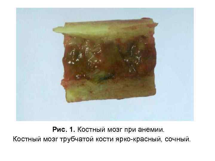 Рис. 1. Костный мозг при анемии. Костный мозг трубчатой кости ярко-красный, сочный. 