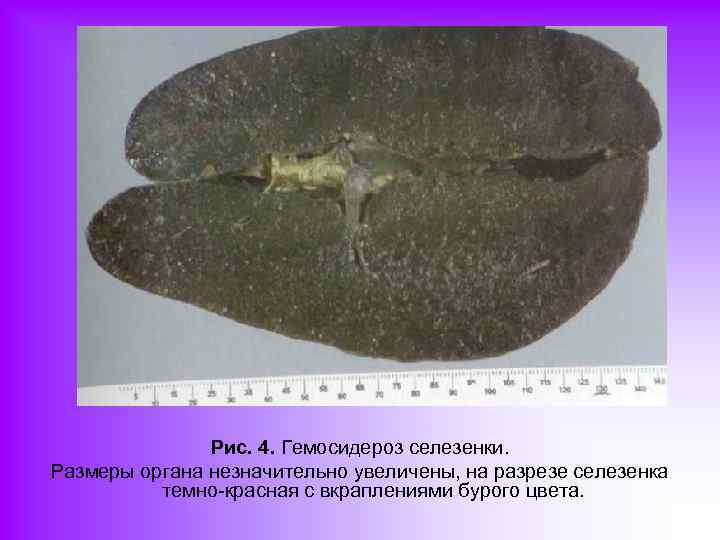 Рис. 4. Гемосидероз селезенки. Размеры органа незначительно увеличены, на разрезе селезенка темно-красная с вкраплениями