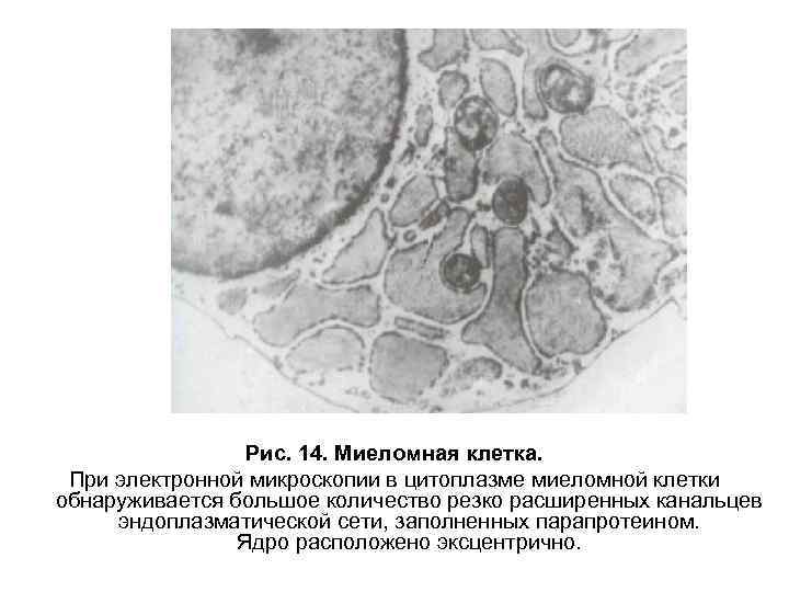 Миеломная болезнь картина крови