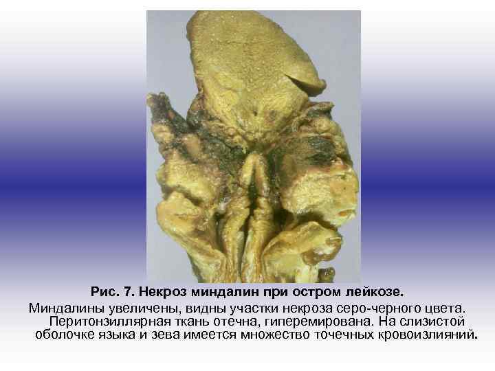 Рис. 7. Некроз миндалин при остром лейкозе. Миндалины увеличены, видны участки некроза серо-черного цвета.