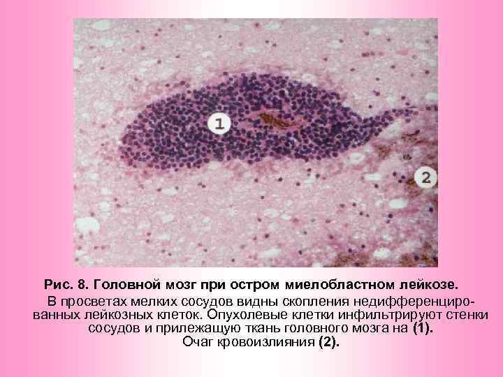Рис. 8. Головной мозг при остром миелобластном лейкозе. В просветах мелких сосудов видны скопления