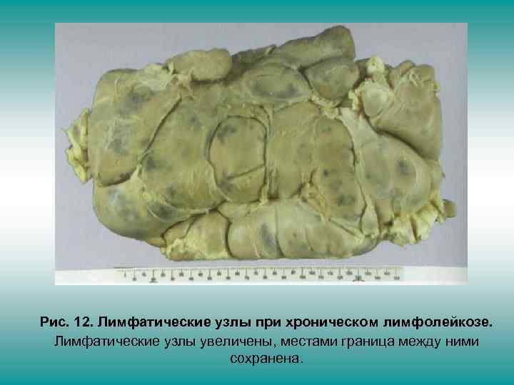 Рис. 12. Лимфатические узлы при хроническом лимфолейкозе. Лимфатические узлы увеличены, местами граница между ними