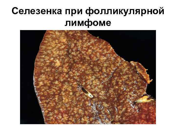 Селезенка при фолликулярной лимфоме 