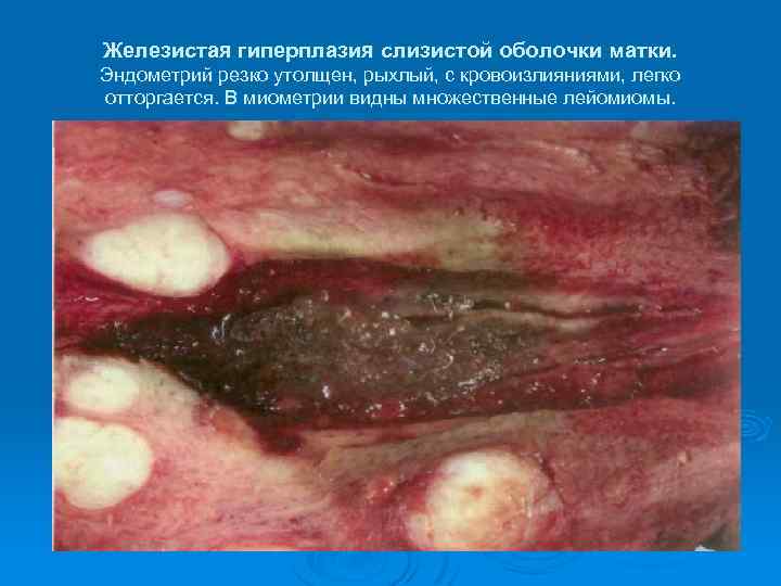 Железистая гиперплазия слизистой оболочки матки. Эндометрий резко утолщен, рыхлый, с кровоизлияниями, легко отторгается. В