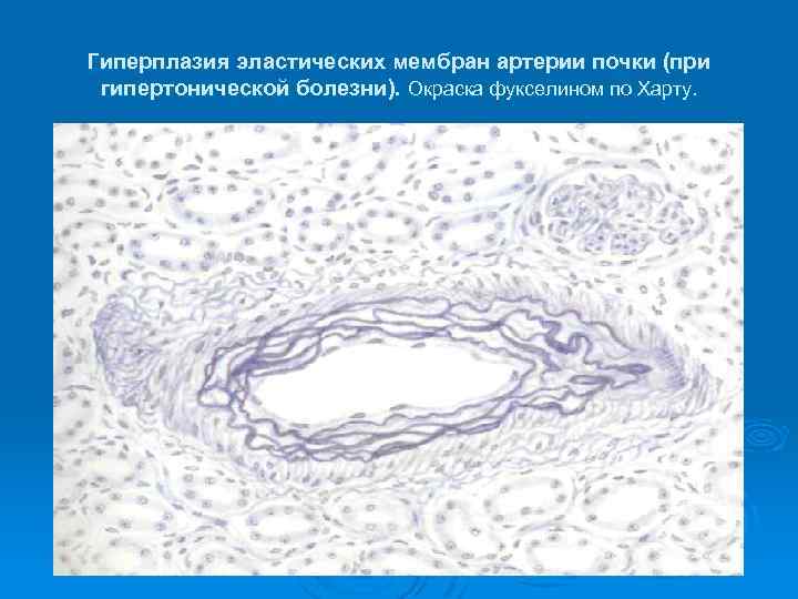 Гиперплазия эластических мембран артерии почки (при гипертонической болезни). Окраска фукселином по Харту. 