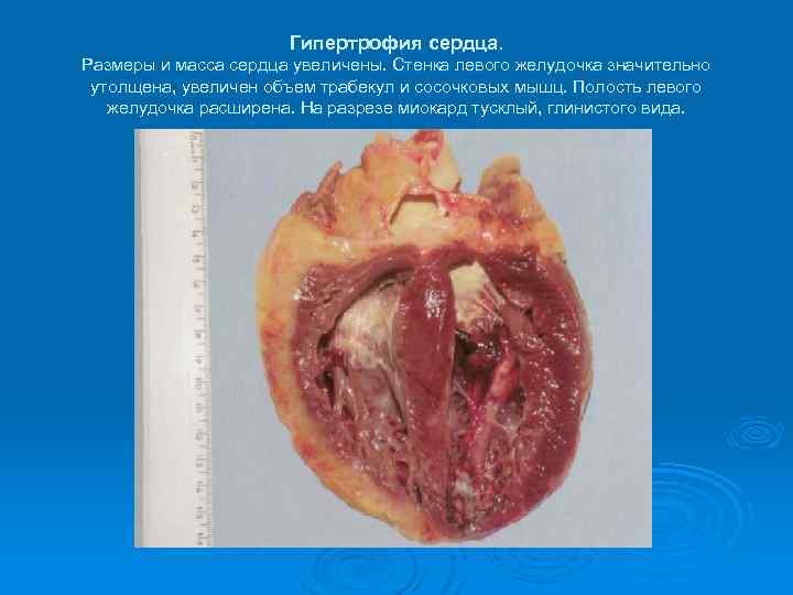 Гипертрофия сердца. Размеры и масса сердца увеличены. Стенка левого желудочка значительно утолщена, увеличен объем