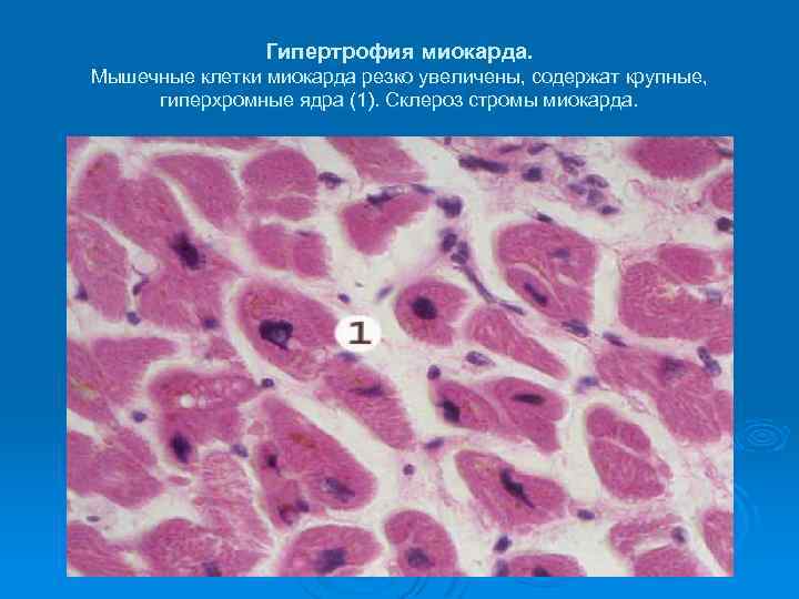 Клетки с гиперхромными ядрами. Гипертрофия кардиомиоцитов патанатомия. Гипертрофия миокарда (окраска гематоксилином-эозином).. Жировая дистрофия кардиомиоцитов гистология. Гипертрофия миокарда гистология.