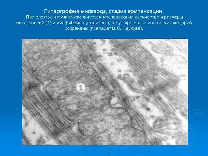 Гипертрофия миокарда, стадия компенсации. При электронно-микроскопическом исследовании количество и размеры митохондрий (1) и миофибрилл