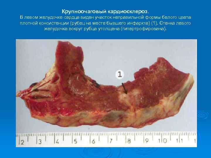 Крупноочаговый кардиосклероз. В левом желудочке сердца виден участок неправильной формы белого цвета плотной консистенции