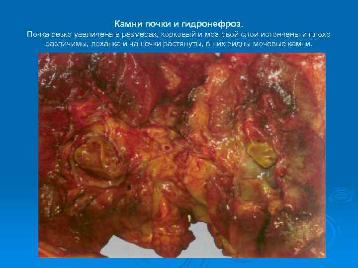 Камни почки и гидронефроз. Почка резко увеличена в размерах, корковый и мозговой слои истончены