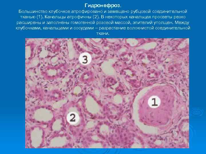 Гидронефроз. Большинство клубочков атрофировано и замещено рубцовой соединительной тканью (1). Канальцы атрофичны (2). В