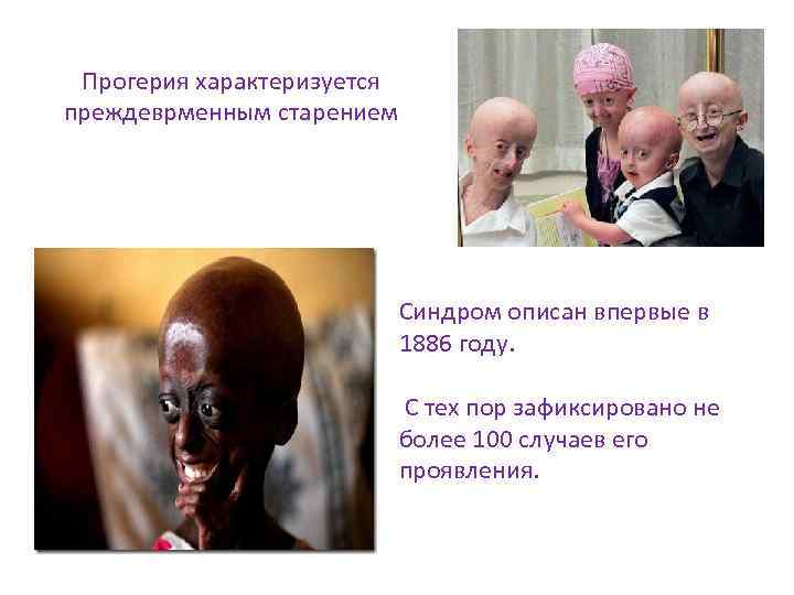 Прогерия характеризуется преждеврменным старением Синдром описан впервые в 1886 году. С тех пор зафиксировано