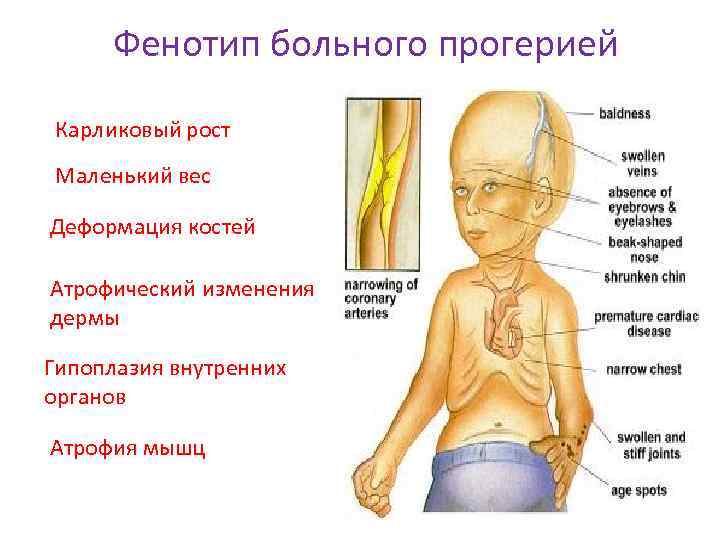 Фенотип больного прогерией Карликовый рост Маленький вес Деформация костей Атрофический изменения дермы Гипоплазия внутренних