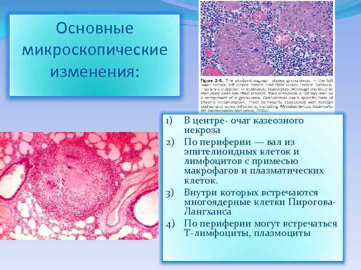 Основные микроскопические изменения: В центре- очаг казеозного некроза 2) По периферии — вал из