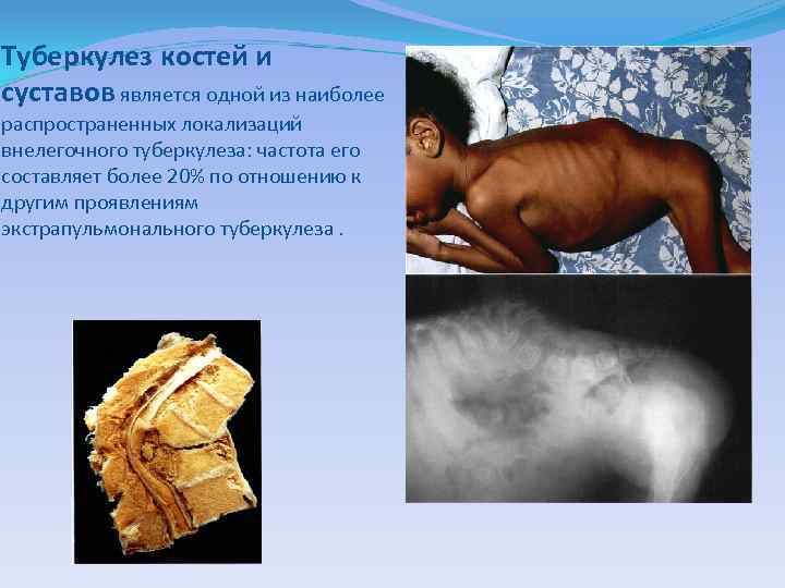 Туберкулез костей и суставов является одной из наиболее распространенных локализаций внелегочного туберкулеза: частота его