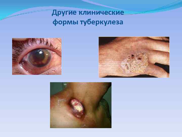 Другие клинические формы туберкулеза 