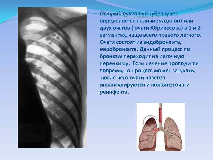 Острый очаговый туберкулез определяется наличием одного или двух очагов ( очаги Абрикосова) в 1