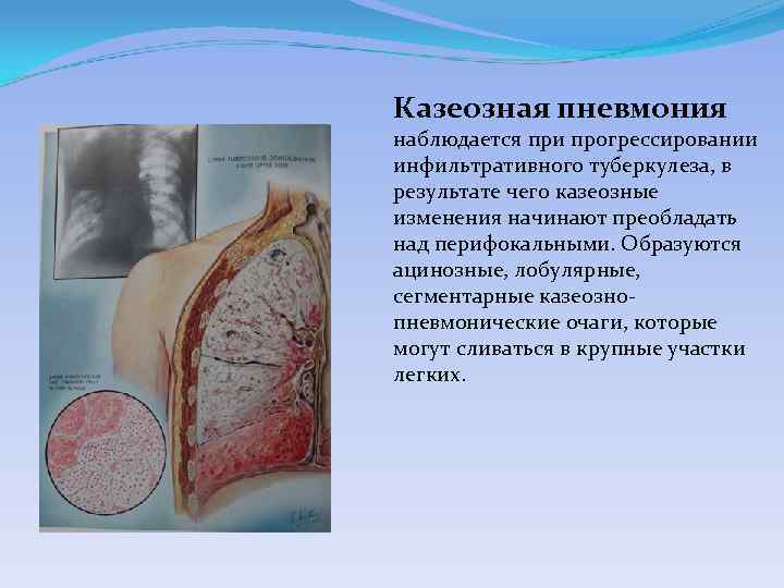 Казеозная пневмония наблюдается при прогрессировании инфильтративного туберкулеза, в результате чего казеозные изменения начинают преобладать