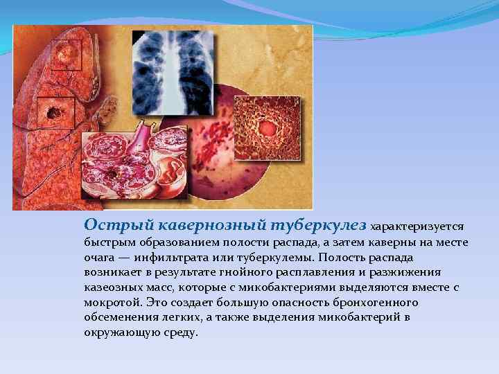 Острый кавернозный туберкулез характеризуется быстрым образованием полости распада, а затем каверны на месте очага