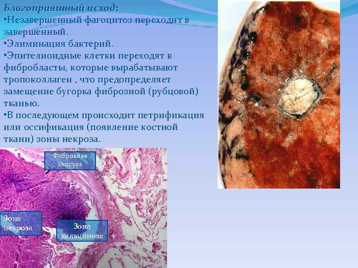 Благоприятный исход: • Незавершенный фагоцитоз переходит в завершенный. • Элиминация бактерий. • Эпителиоидные клетки