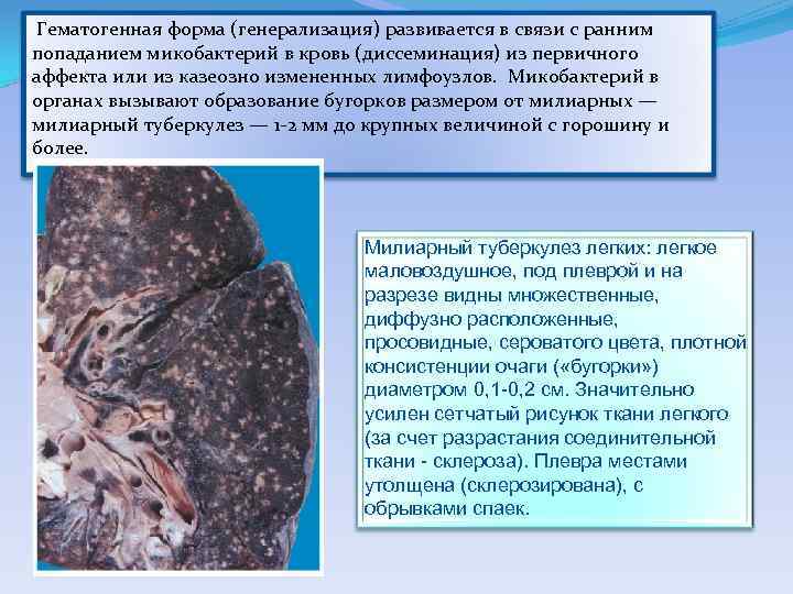  Гематогенная форма (генерализация) развивается в связи с ранним попаданием микобактерий в кровь (диссеминация)
