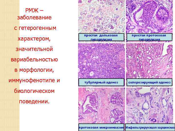 РМЖ – заболевание с гетерогенным характером, простая дольковая гиперплазия простая протоковая гиперплазия тубулярный аденоз