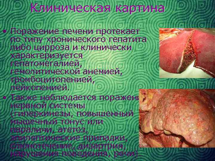 Клиническая картина • Поражение печени протекает по типу хронического гепатита либо цирроза и клинически