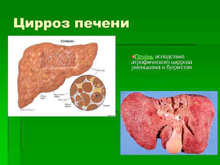 Цирроз печени Печень вследствие атрофического цирроза уменьшена и бугристая 