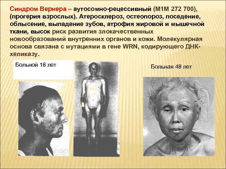 Синдром Вернера – аутосомно-рецессивный (М 1 М 272 700), (прогерия взрослых). Атеросклероз, остеопороз, поседение,