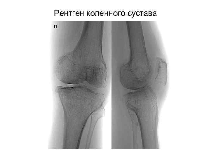 Рентген коленного сустава 