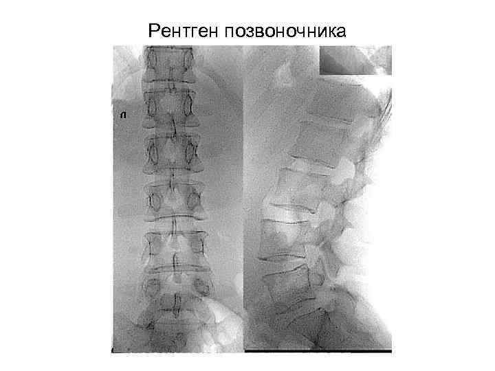 Рентген позвоночника 