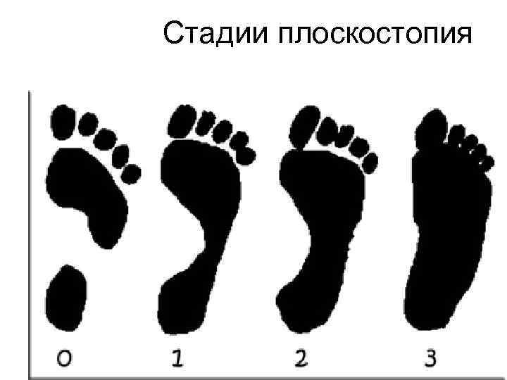 Стадии плоскостопия 