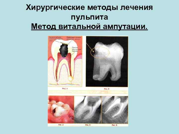 Хирургические методы лечения пульпита Метод витальной ампутации. 