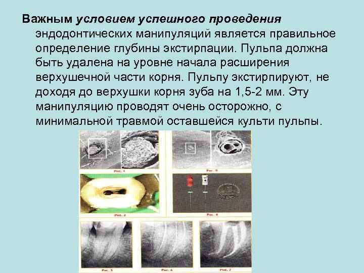 Важным условием успешного проведения эндодонтических манипуляций является правильное определение глубины экстирпации. Пульпа должна быть