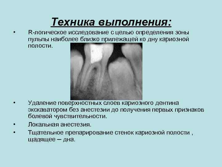 Техника выполнения: • R-логическое исследование с целью определения зоны пульпы наиболее близко прилежащей ко