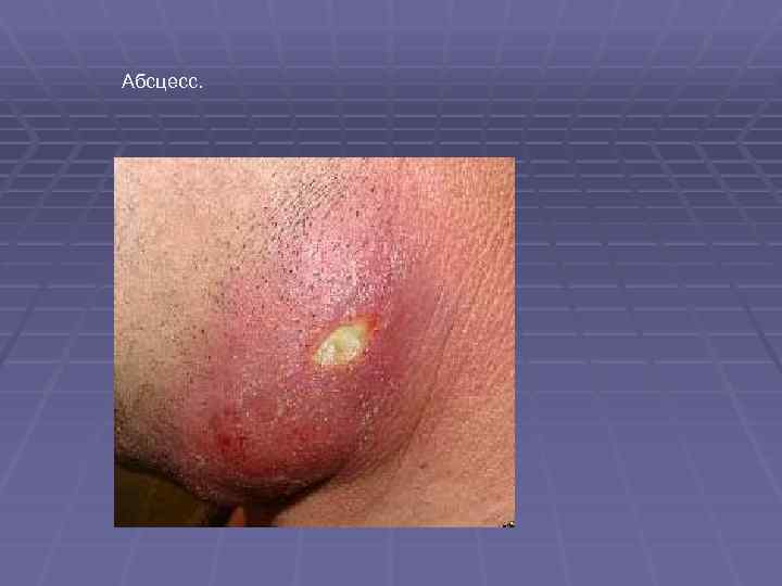 Абсцесс. 