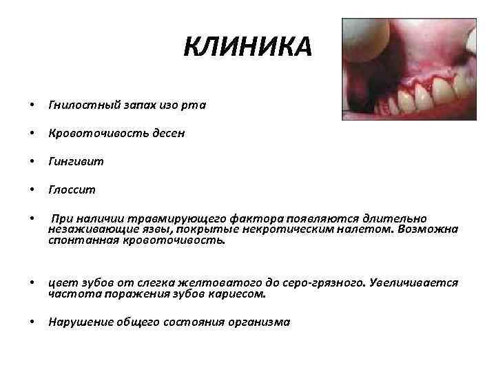 КЛИНИКА • Гнилостный запах изо рта • Кровоточивость десен • Гингивит • Глоссит •