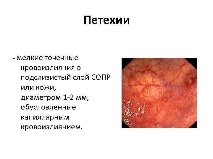 Петехии - мелкие точечные кровоизлияния в подслизистый слой СОПР или кожи, диаметром 1 -2