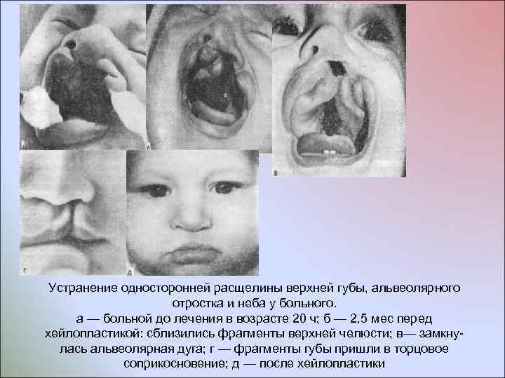 Устранение односторонней расщелины верхней губы, альвеолярного отростка и неба у больного. а — больной